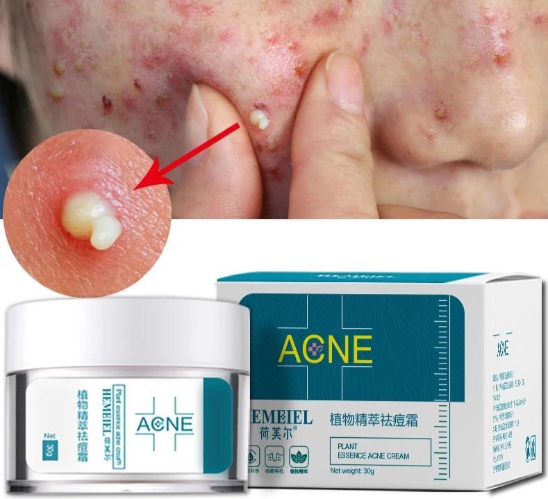 Acne cream